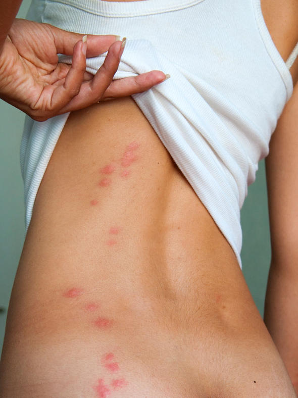 Bed Bug Bites & Rash: Pictures, Symptoms, Treatment ...